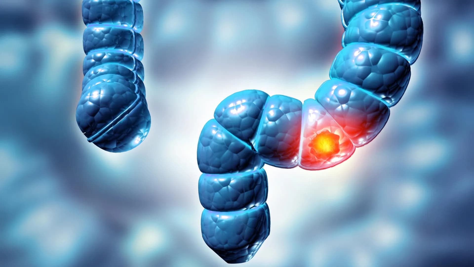 Major Study Links Colon Polyps to 5x Higher Cancer Risk