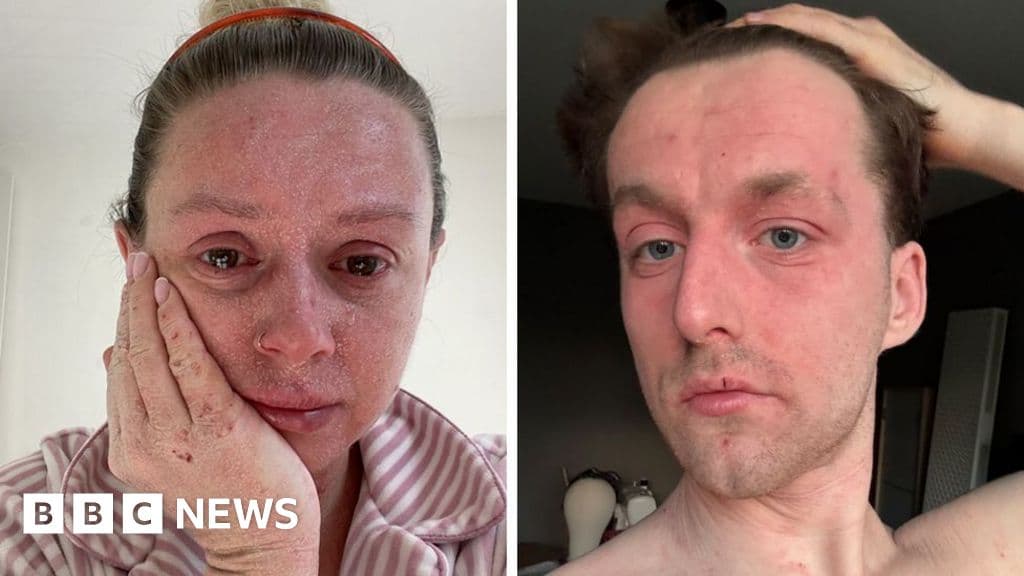 Shocking Truth About Topical Steroid Withdrawal Revealed