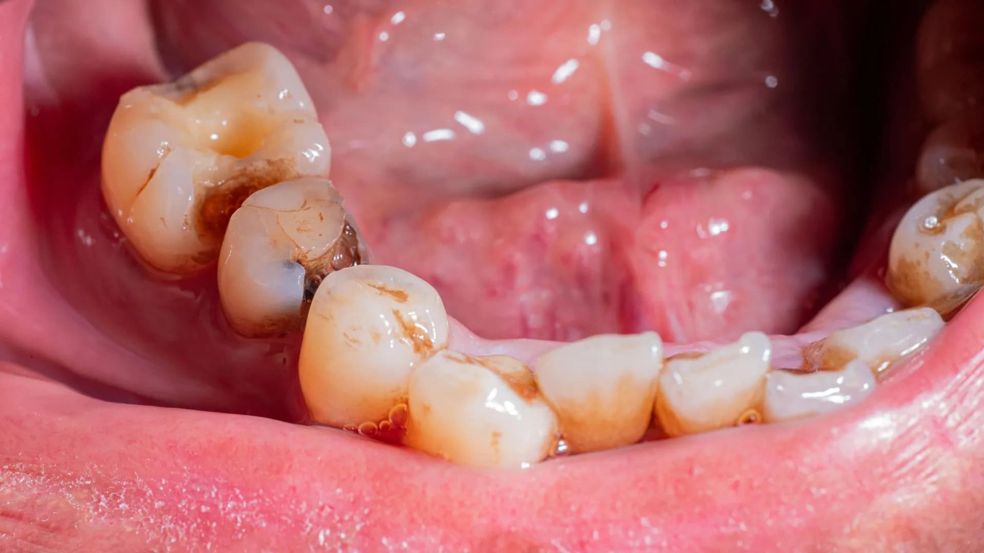 Revolutionary Study: Tooth Infections Impact Heart Health
